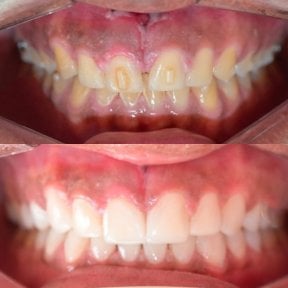 Before and after composite veneer results at Punta cana dentist odontologia familiar, smile makeover
