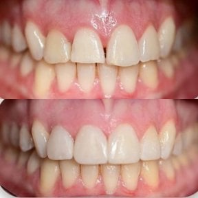 Before and after veneers result at Punta cana dentist odontologia familiar, smile transformation