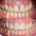 Before and after veneers result at Punta cana dentist odontologia familiar, smile transformation
