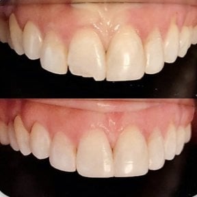 Before and after veneers result at Punta cana dentist odontologia familiar, improved smile aesthetics