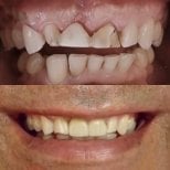 Before and after zirconia veneers result at Punta cana dentist odontologia familiar, smile makeover