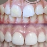 Before and after tooth restoration (bonding) results at Punta cana dentist odontologia familiar