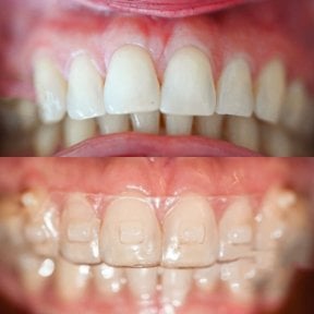 Before and after Invisalign results at Punta cana dentist odontologia familiar, teeth alignment