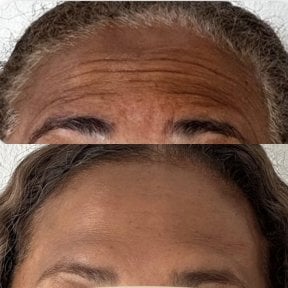 Before and after Botox for forehead wrinkles at Punta cana dentist odontologia familiar, smooth result