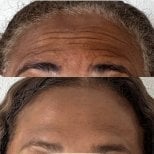 Before and after Botox for forehead wrinkles at Punta cana dentist odontologia familiar, smooth result