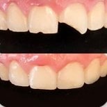 Efekty przed i po odbudowie zęba bondingiem w Punta cana dentist odontologia familiar, naprawa ukruszenia