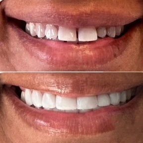 Before and after tooth restoration bonding results at Punta cana dentist odontologia familiar clinic