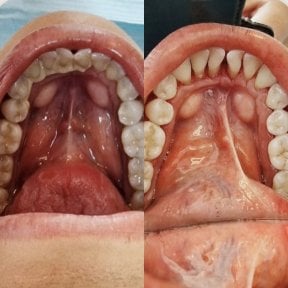 Before and after tooth restoration bonding at Punta cana dentist odontologia familiar, improved smile result
