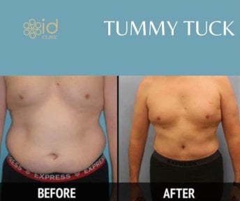 before-after photo liposuction
