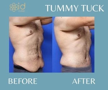 before-after photo liposuction