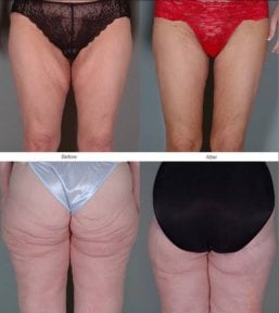 before-after photo liposuction