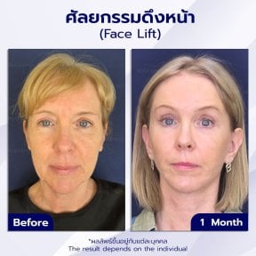 before-after photo rhinoplasty-nose-job