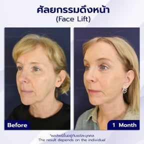 before-after photo rhinoplasty-nose-job