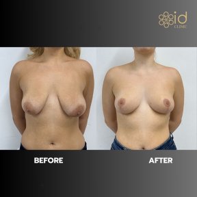before-after photo mastopeksia-podtazka-grudi-konturnaa-plastika