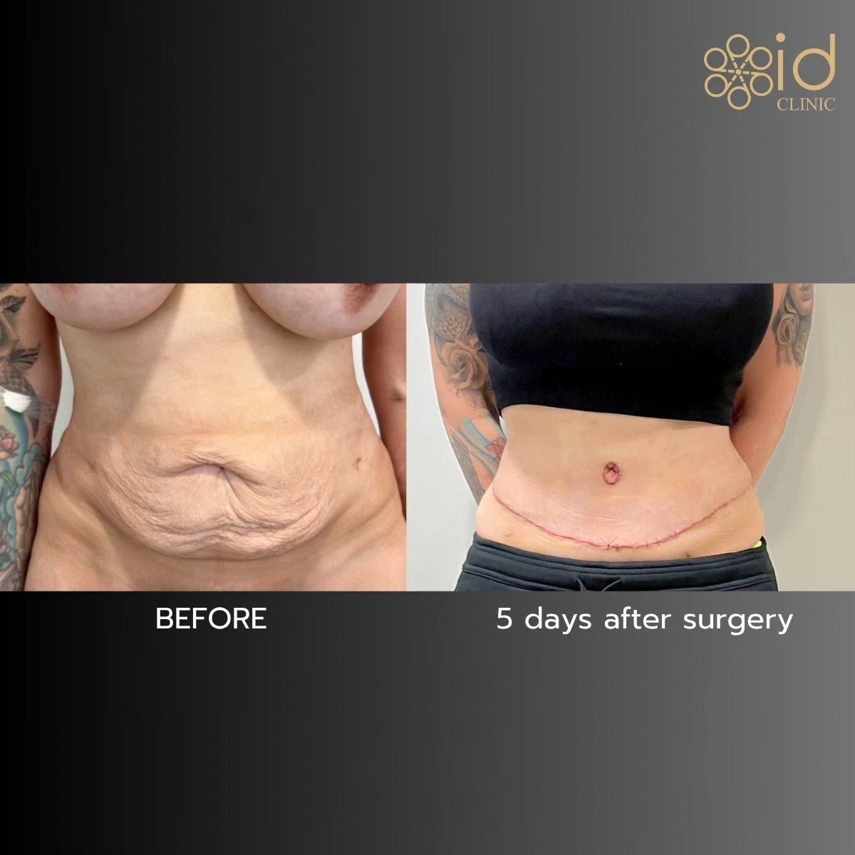 Resultados de abdominoplastia y liposucción en ID Clinic Bangkok, abdomen más plano