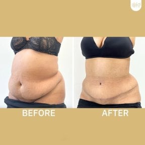 before-after photo tummy-tuck-and-liposuction