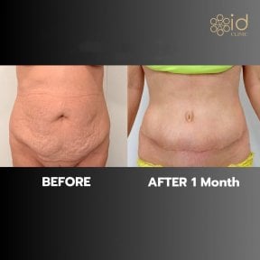 before-after photo tummy-tuck-and-liposuction