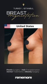 before-after photo brazilian-butt-lift