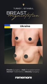 before-after photo brazilian-butt-lift