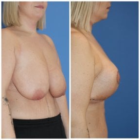before-after photo breast-reduction