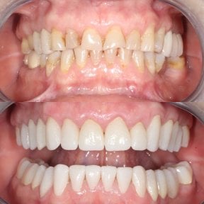 before-after photo zirconia-crown-installation