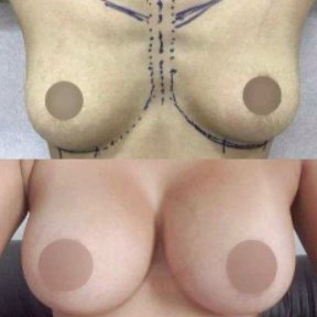 before-after photo breast-augmentation