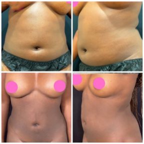 Before and after Vaser liposuction results at Somchai Clinic, visible body contour improvement