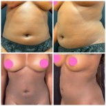 Before and after Vaser liposuction results at Somchai Clinic, visible body contour improvement