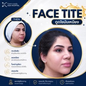 before-after photo double-chin-liposuction