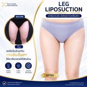 before-after photo double-chin-liposuction