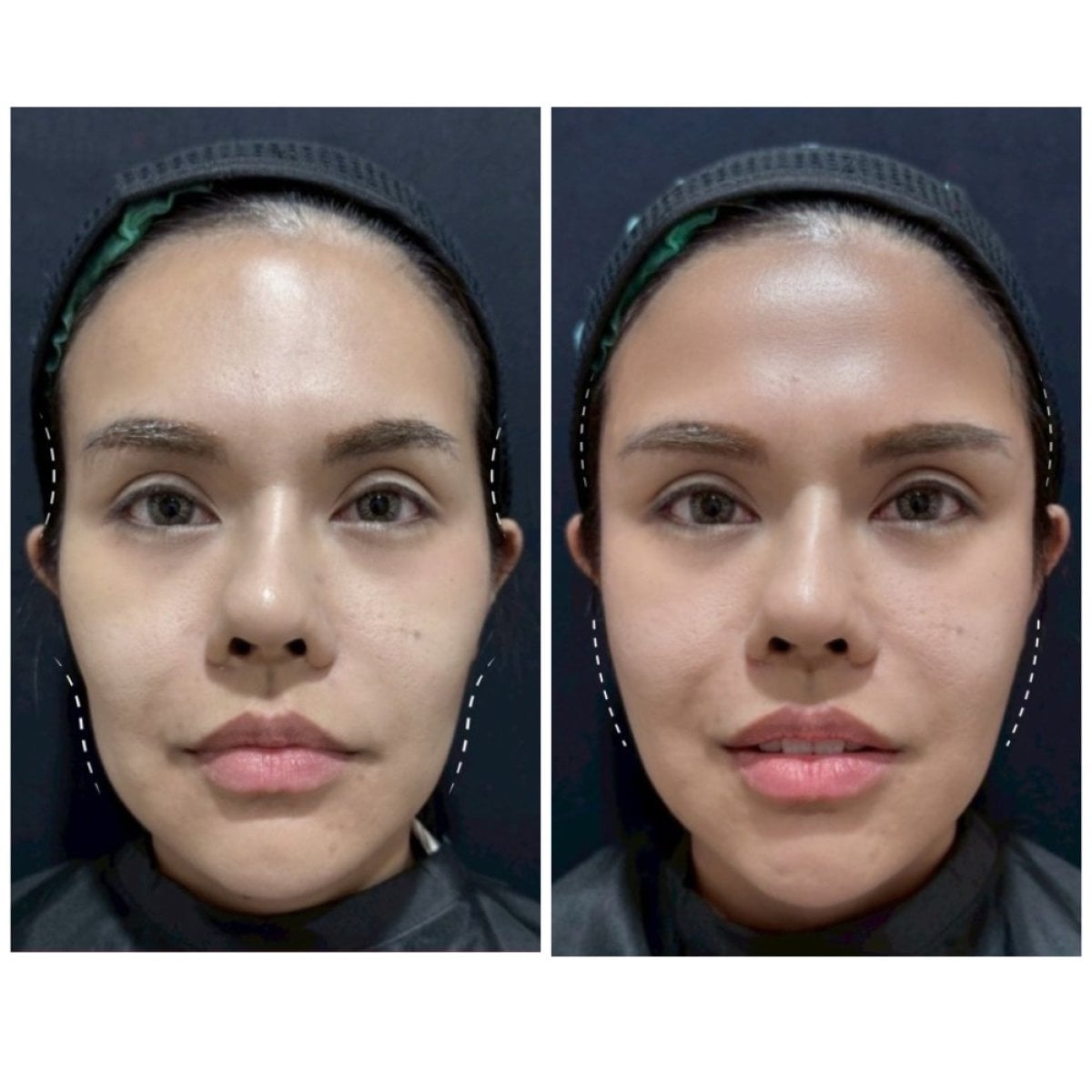 Resultados antes y después de rellenos en Somchai Clinic, mejora del contorno facial