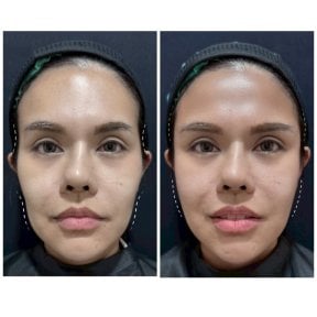 Before and after fillers injection result at Somchai Clinic, enhanced facial contour and volume