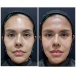 Before and after fillers injection result at Somchai Clinic, enhanced facial contour and volume