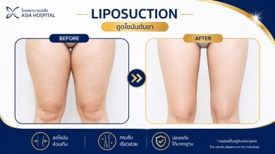 before-after photo double-chin-liposuction