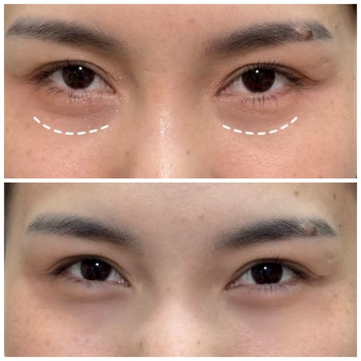 Antes y después de rellenos bajo los ojos en Somchai Clinic, mejora visible del surco lagrimal