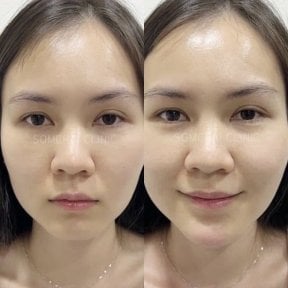 Результат до и после инъекций филлеров в Somchai Clinic, улучшенный объем лица
