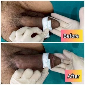 before-after photo penile-curvature-correction-surgical-treatment-for-peyronies-disease