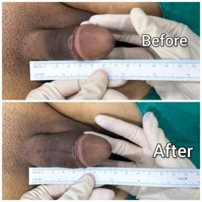 before-after photo penile-curvature-correction-surgical-treatment-for-peyronies-disease