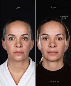 Результати до і після Deep Plane Facelift у клініці Vidnova – омолодження обличчя