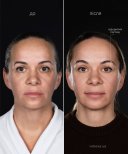 Результати до і після Deep Plane Facelift у клініці Vidnova – омолодження обличчя