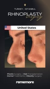 Résultats avant et après rhinoplastie à Memorial Bahçelievler Hospital, remodelage du nez