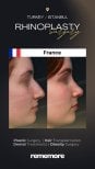 Résultats avant/après rhinoplastie à Memorial Bahçelievler Hospital, chirurgie du nez