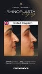 Résultats avant et après rhinoplastie à Memorial Bahçelievler Hospital, remodelage du nez