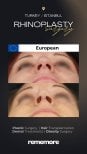 Résultats avant et après rhinoplastie chez une patiente européenne à Memorial Bahçelievler