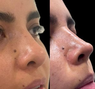 before-after photo rhinoplasty-nose-job