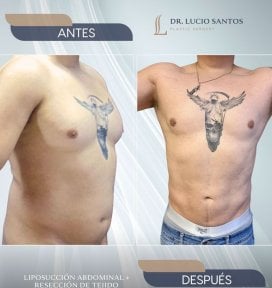 Vorher-nachher-Ergebnis Brustliposuktion beim Mann in Lucio Santos Plastic Surgery, sichtbare Kontur