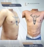 Vorher-nachher-Ergebnis Brustliposuktion beim Mann in Lucio Santos Plastic Surgery, sichtbare Kontur