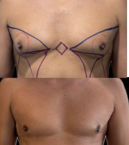 before-after photo vaser-liposuction