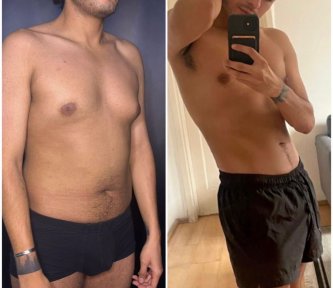 before-after photo vaser-liposuction