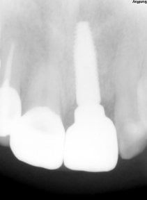 before-after photo dental-implant